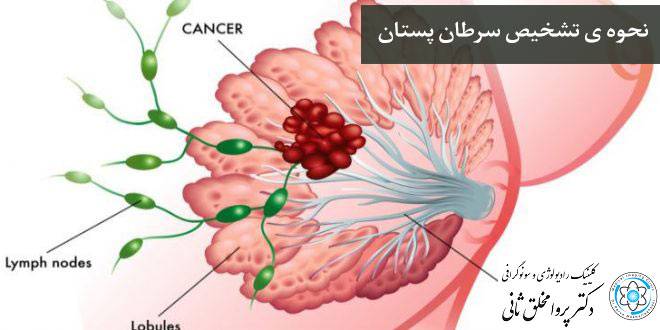 نحوه ی تشخیص سرطان پستان