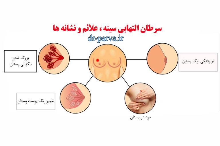 سرطان التهابی سینه ، علائم و نشانه ها و نحوه درمان