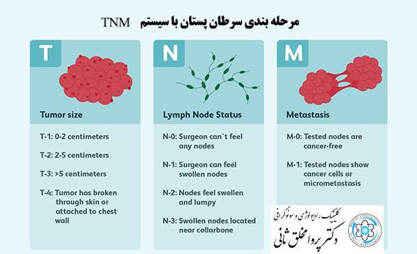 مرحله بندی سرطان پستان با سیستم TNM